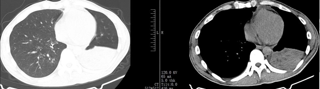 男23岁因上呼吸道感染剧烈咳嗽,34岁小伙咳嗽一个星期了