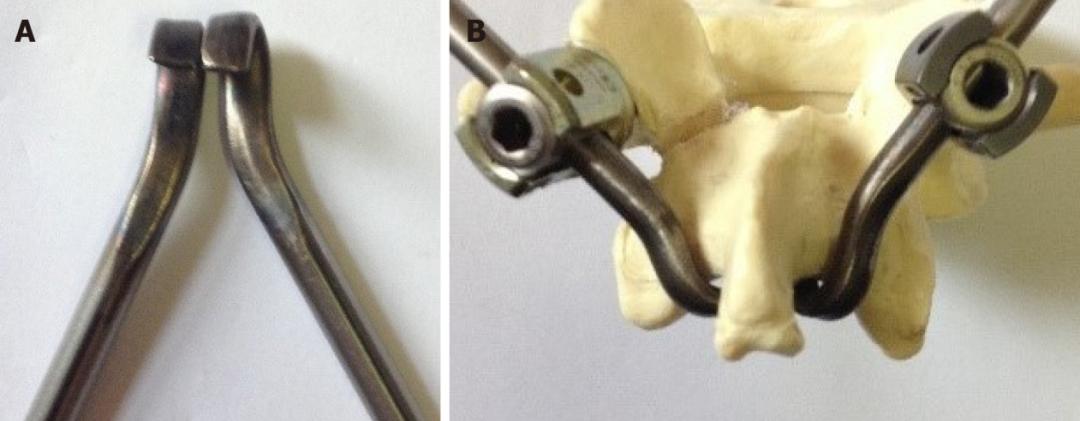 轻度峡部裂和重度峡部裂的区别,真性峡部裂和假性峡部裂