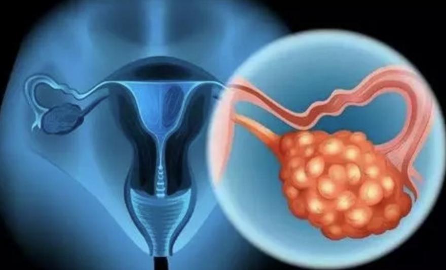 卵巢鳞状细胞癌的复发率是否很高,卵巢癌复发后复发期越来越短吗