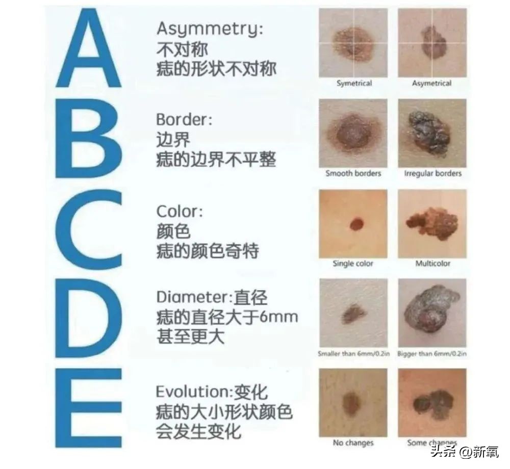 胸上有一颗痣会危险吗,胸上突然长了一颗痣什么征兆