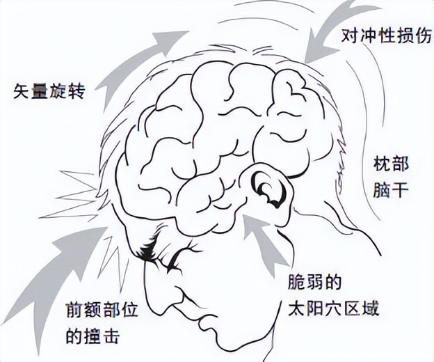 门医科普|脑外伤不是治好了吗？为什么还总是发作癫痫？