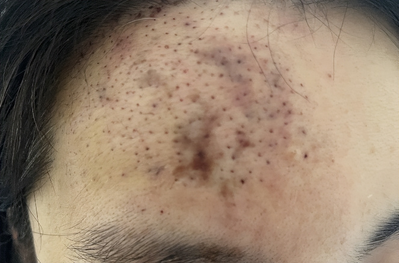 玻尿酸栓塞几个小时内出现问题,栓塞玻尿酸栓塞的概率高吗