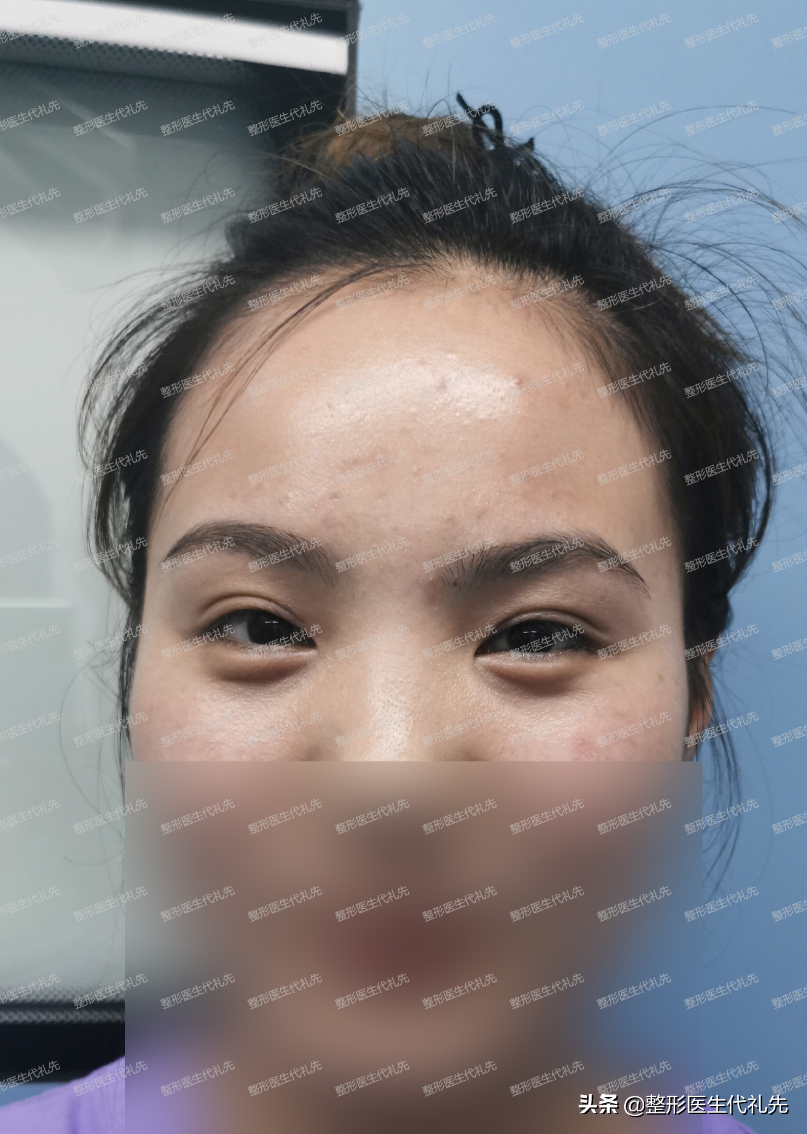 眼袋外切卧蚕留下卧蚕图片,眼袋和卧蚕有什么区别怎么祛眼袋