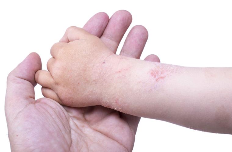 医学科普湿疹做好这几点减少复发,谈谈湿疹的中医药防治与调养