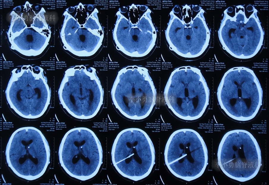 脑积水三脑室造瘘多久能恢复,脑囊虫手术后脑积水