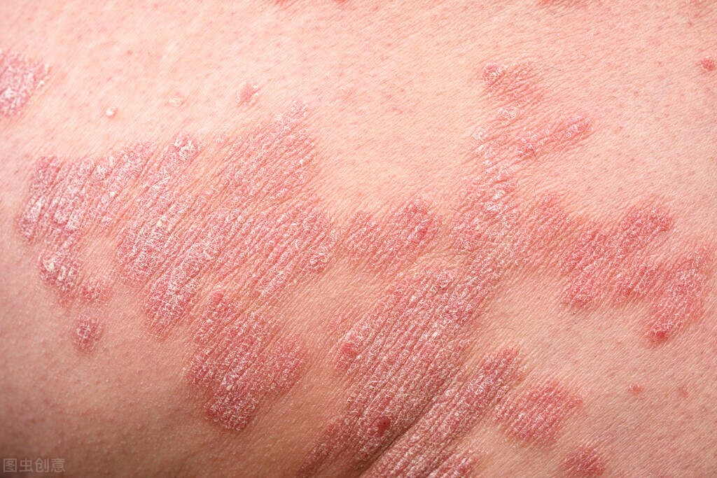 怎么区分皮炎和癣的区别,皮炎和癣怎么区分