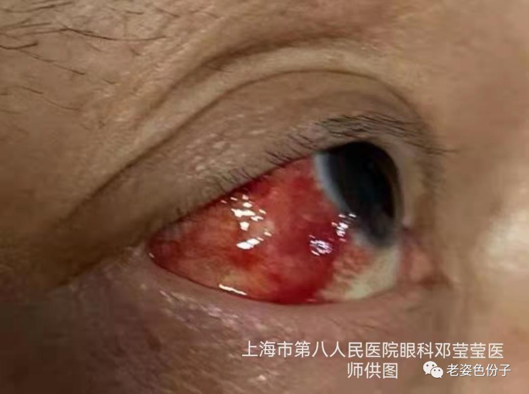 疫情期间鼻子出血要去医院吗,疫情期间眼病要立即治疗吗