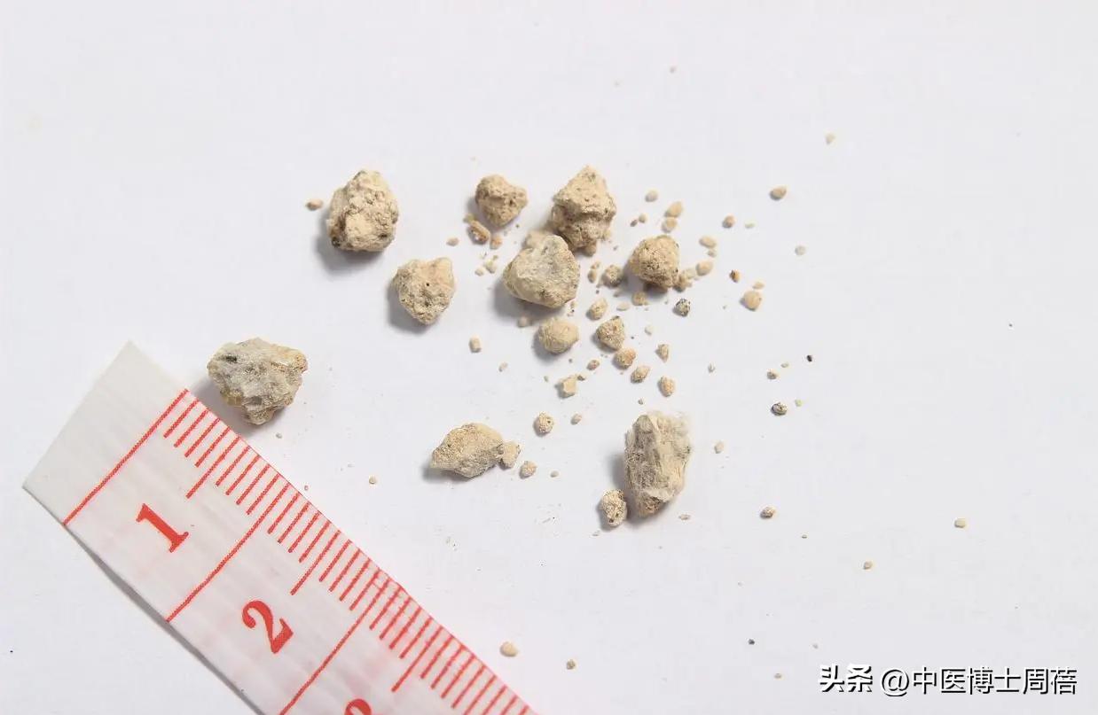 泥沙状胆结石中药能排出吗,胆结石吃中药多久能排出