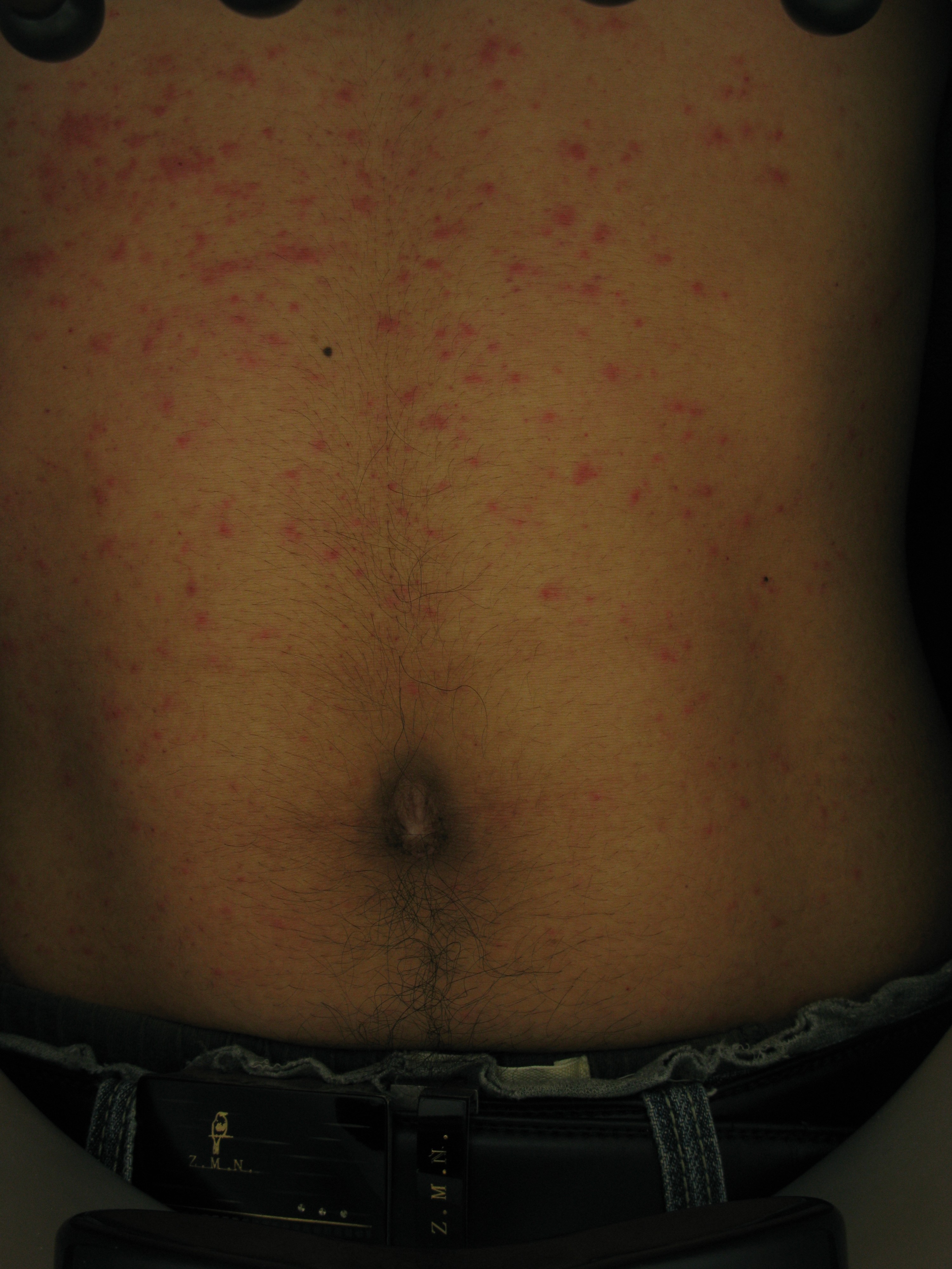 过敏性紫癜小腿反复出现出血点,过敏性紫癜老反复起小红点怎么办