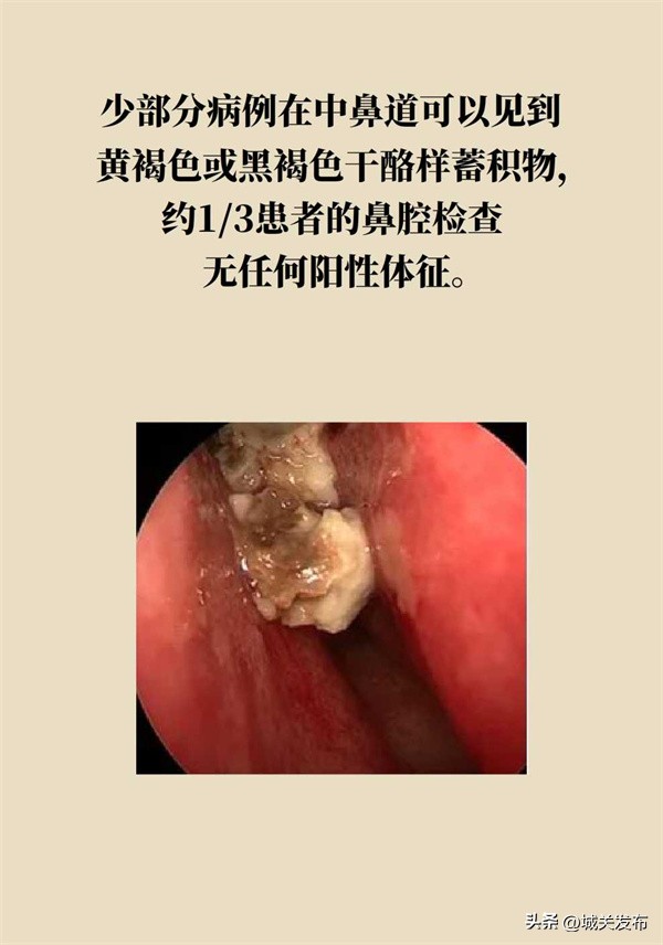 鼻子发霉怎么办,鼻子里因为异物发臭用什么药处理