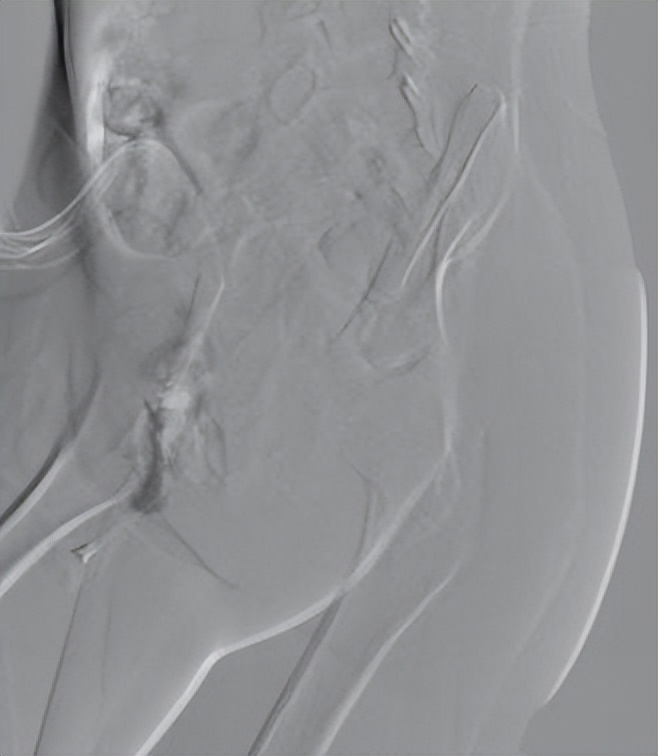 下肢肌间静脉畸形治疗案例,臀部静脉畸形怎么治疗比较好