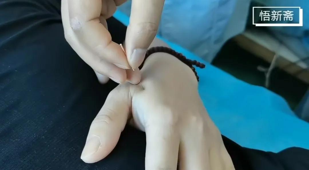 开四关可以治疗抑郁症吗,开四关穴能治哪些病