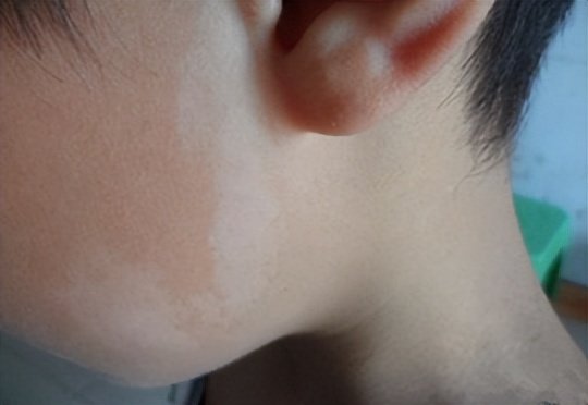 白斑是白癜风还是糠疹如何鉴别呢,白斑处毛发变白就一定是白癜风吗