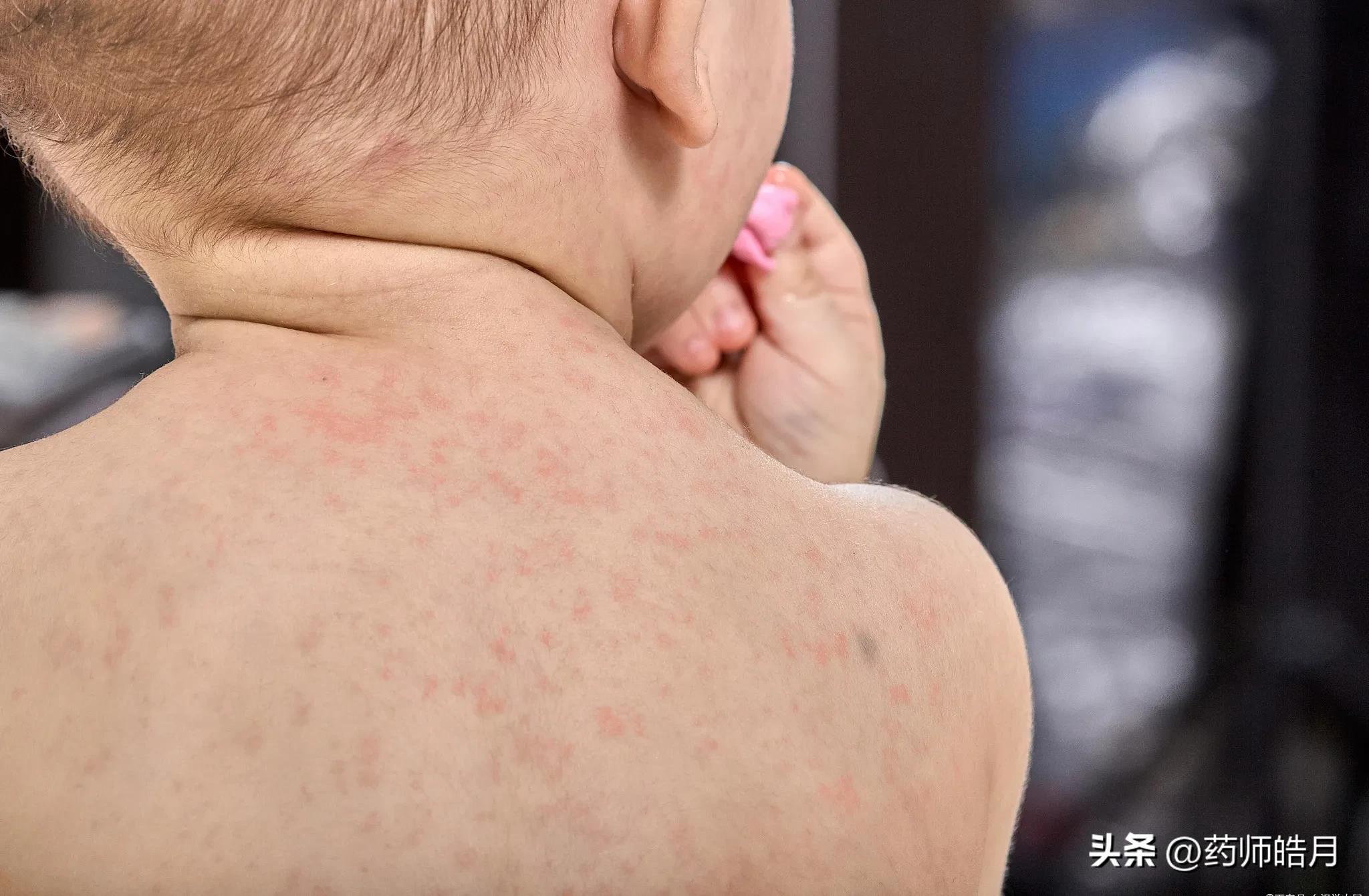 肛周瘙痒湿疹反复发作怎么办,宝宝过敏体质湿疹反复怎么办