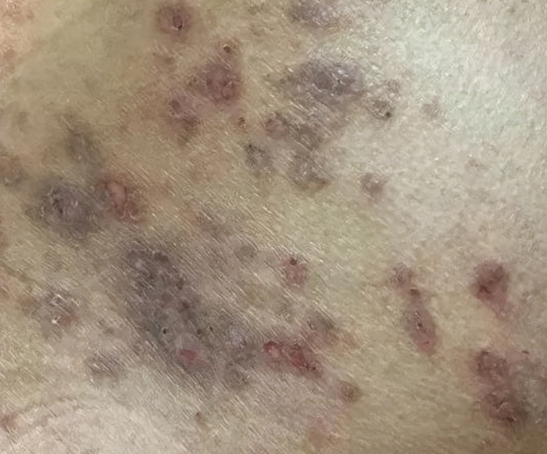 医生检查阴虱的镊子和刀片,男子发现阴虱