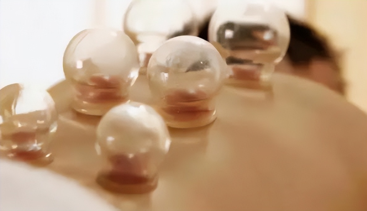 拔火罐吸出来的是湿气还是毒素,拔火罐吸出来的瘀血是体内毒素吗