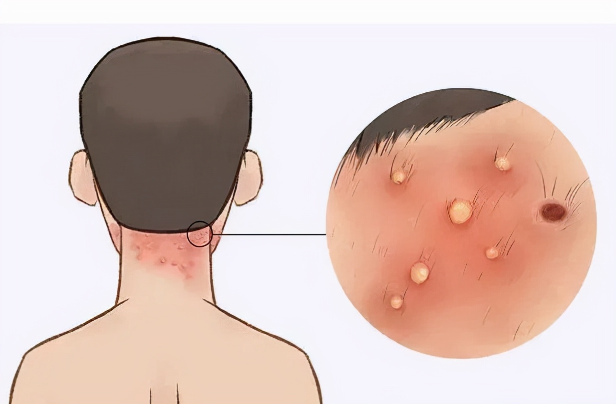 头皮毛囊炎去哪里看,头皮毛囊炎一招解决