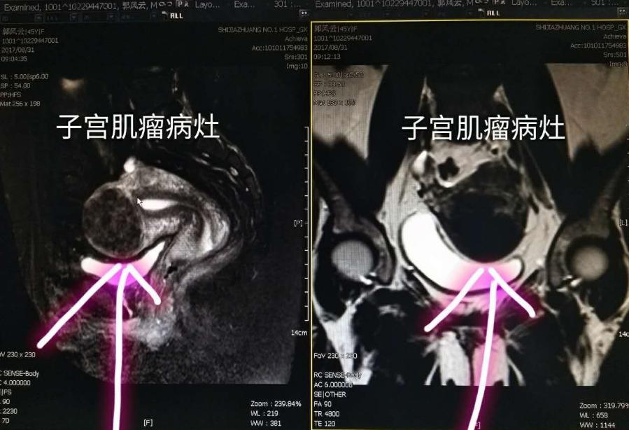 女人没了子宫对身体有什么危害吗,女性没了子宫的影响