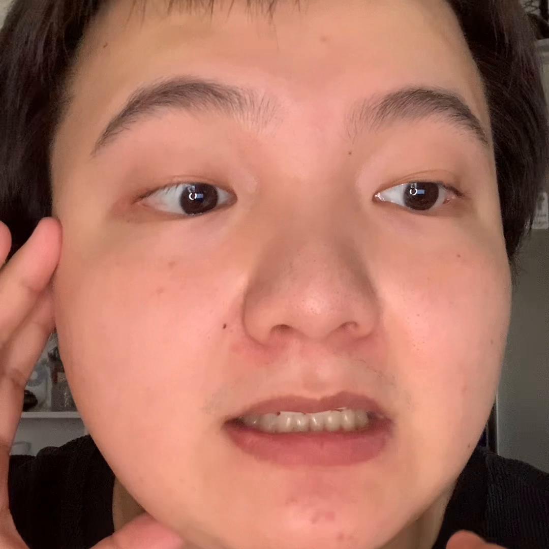 博乐达水杨酸可以修复痘坑吗,博乐达水杨酸能不能细致毛孔