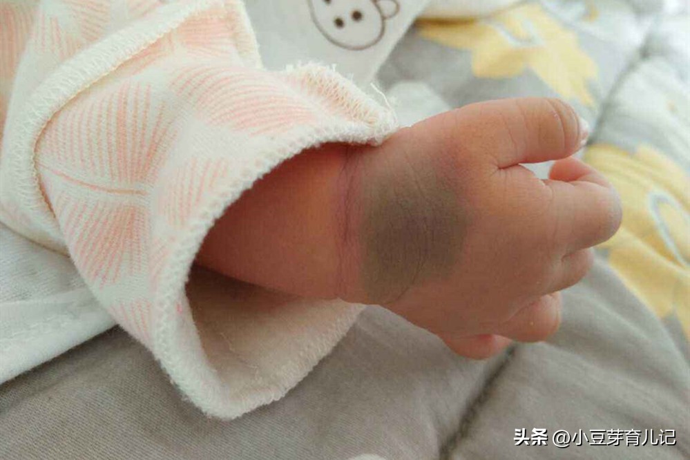 宝宝大腿后突然淤青一块,宝宝大腿有淤青怎么回事