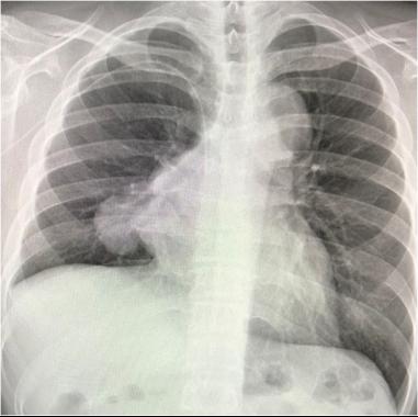 “港澳药械通”惠及湾区患者，26岁港人患罕见血液肿瘤在深获治