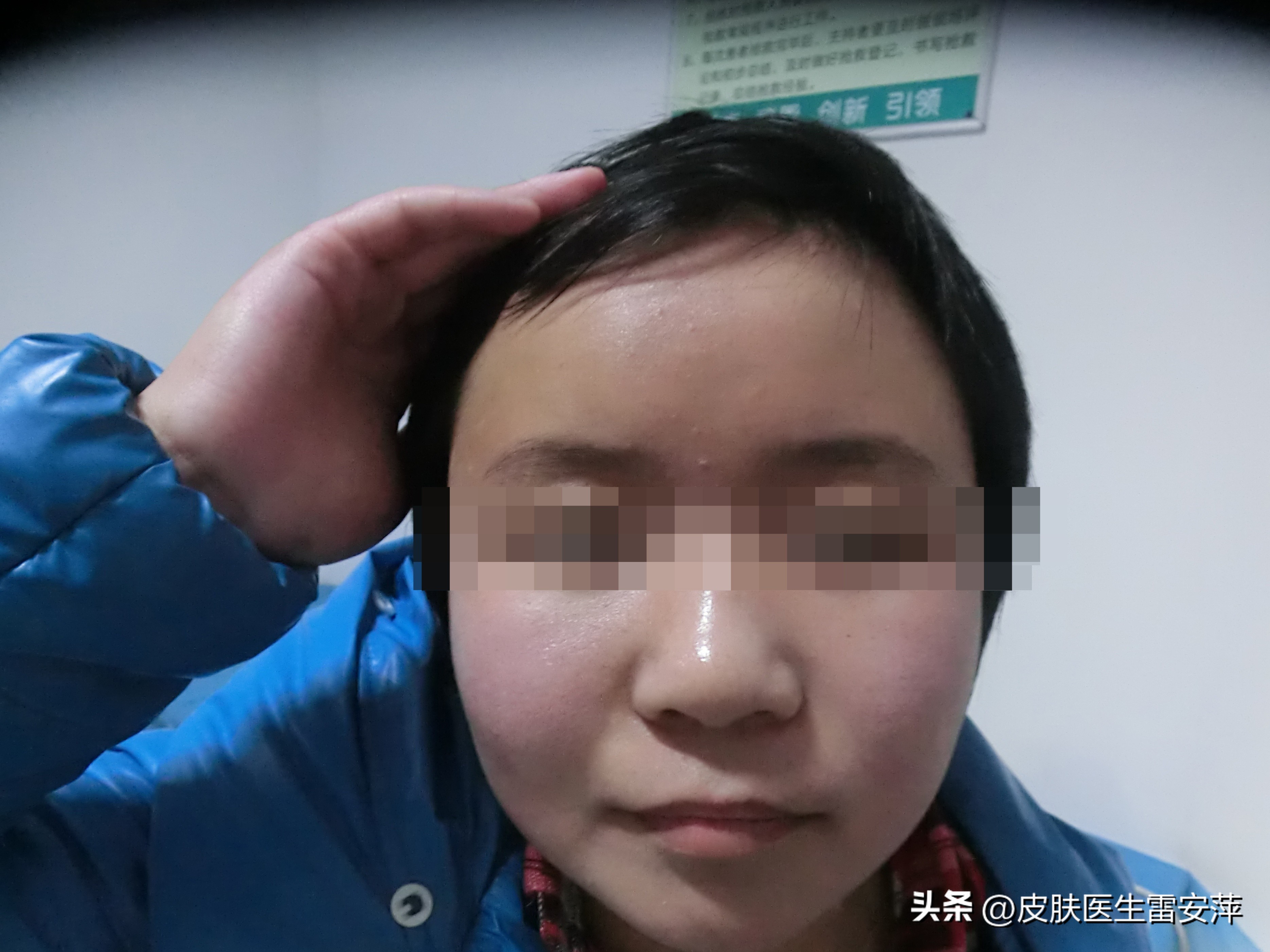 白癜风为什么边治疗边扩大,白癜风患者脸上有斑可以去掉吗