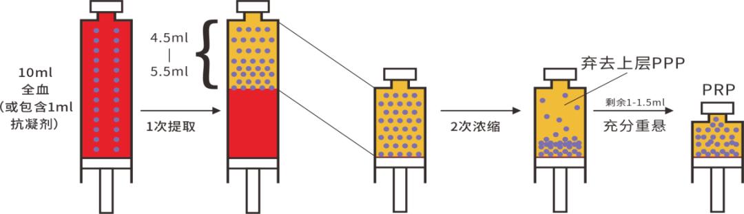 关节prp治疗要打麻药吗,风湿性关节炎prp