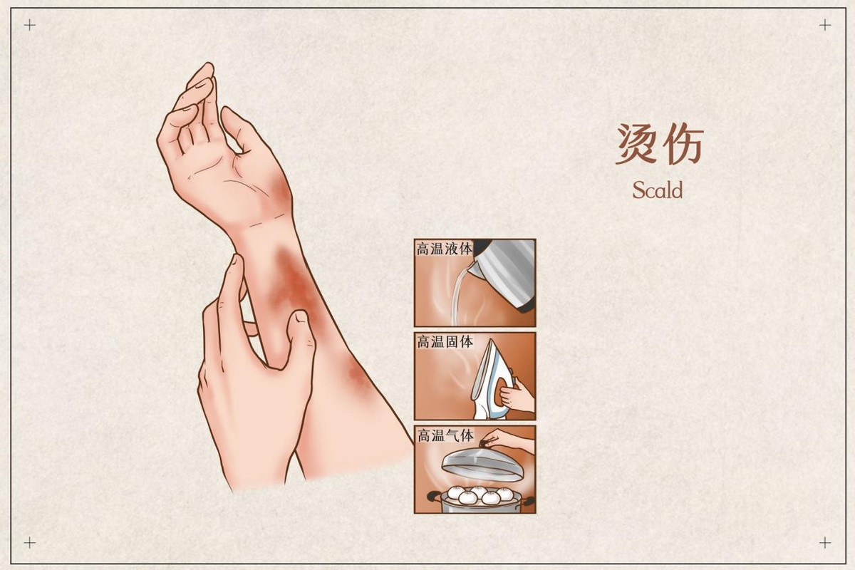 发生高温烫伤事故应急措施,皮肤烫伤怎么处理好得快