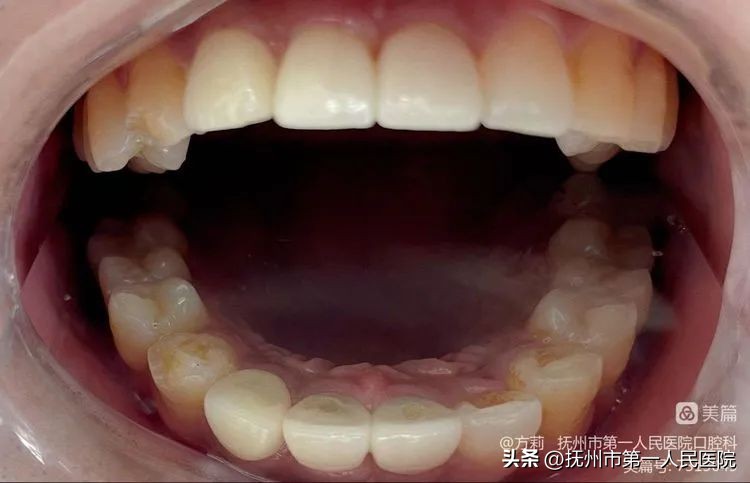种植牙可修复多种牙齿缺失类型,学科建设口腔科