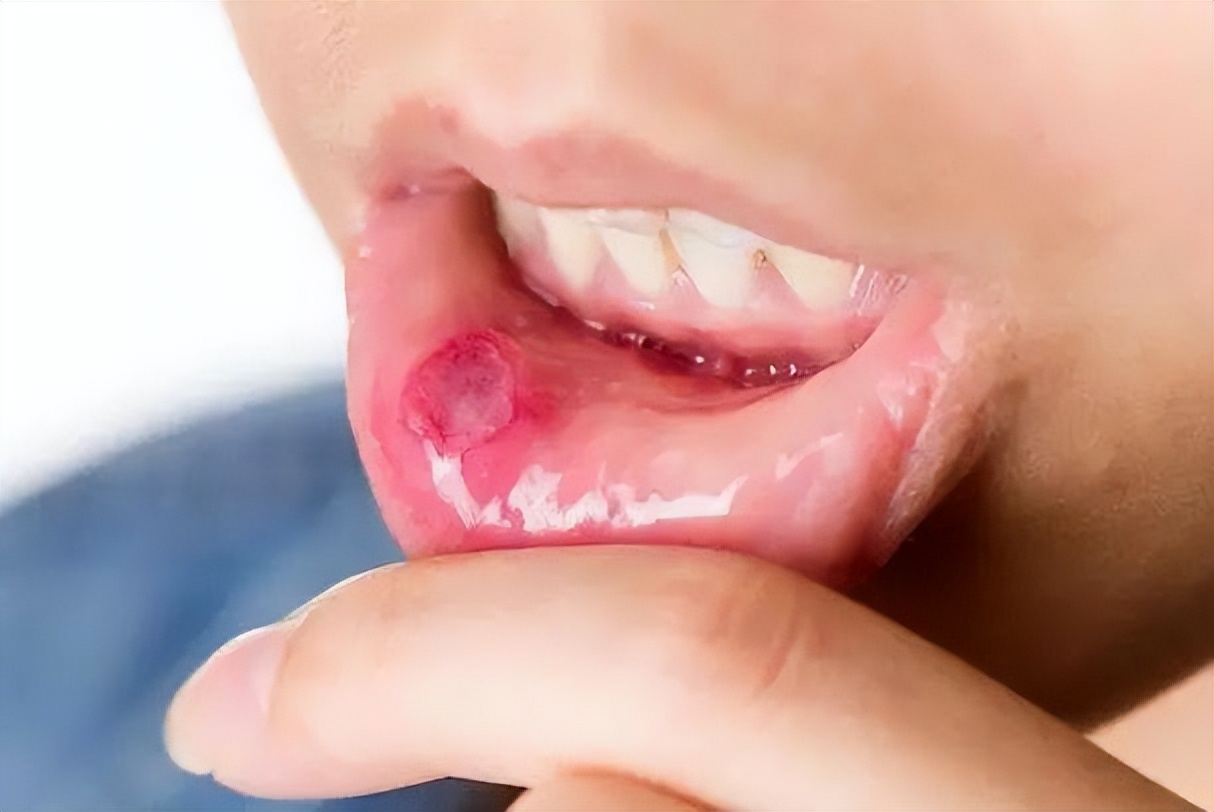 口腔溃疡和口腔癌早期症状的区别,口腔溃疡和溃疡性口腔癌症状区别