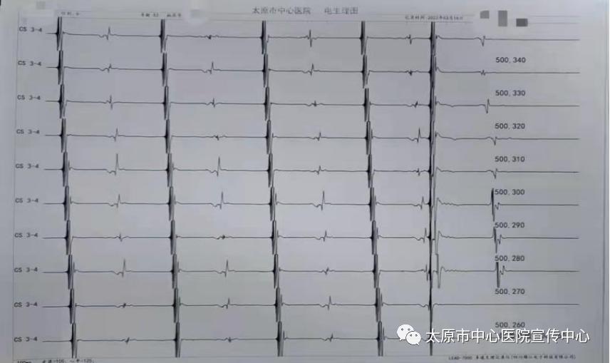 射频消融术怎么治疗心律失常,射频消融术治疗心律失常