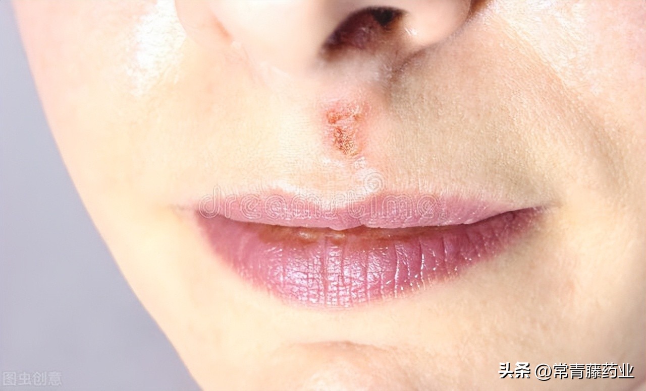 嘴上长水泡，居然是感染疱疹病毒！如何才能快速消除？能挑破吗？