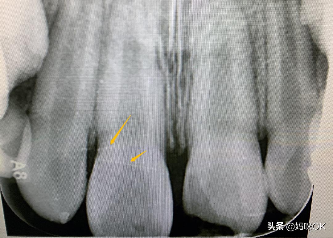 18岁前不能再用门牙吃东西！儿子的这一跤摔得有点惨痛