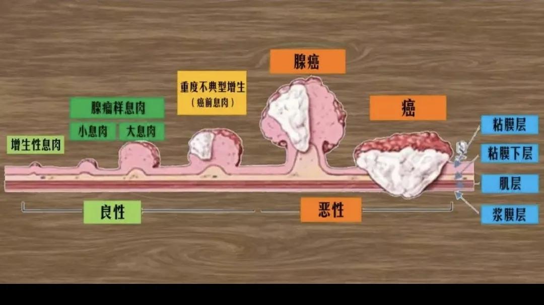 体检报告出现“息肉”，5种常见息肉哪些是良性，哪些会癌变？
