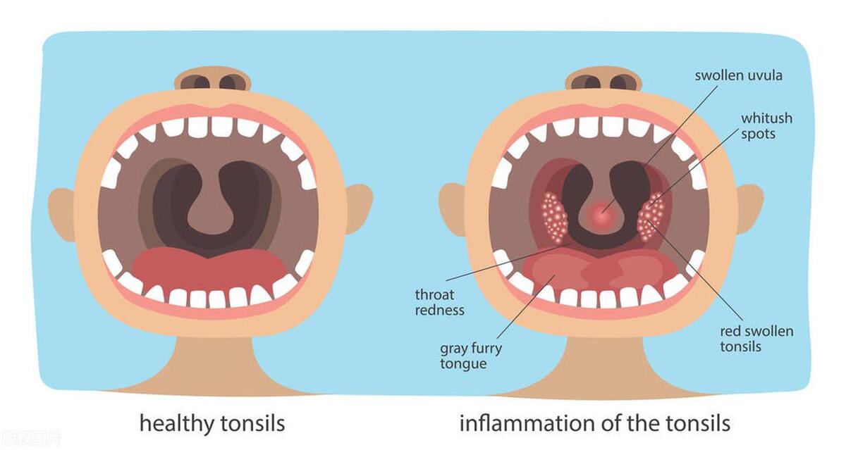 娃娃受凉感冒吃什么药,娃娃感冒了吃什么比较好
