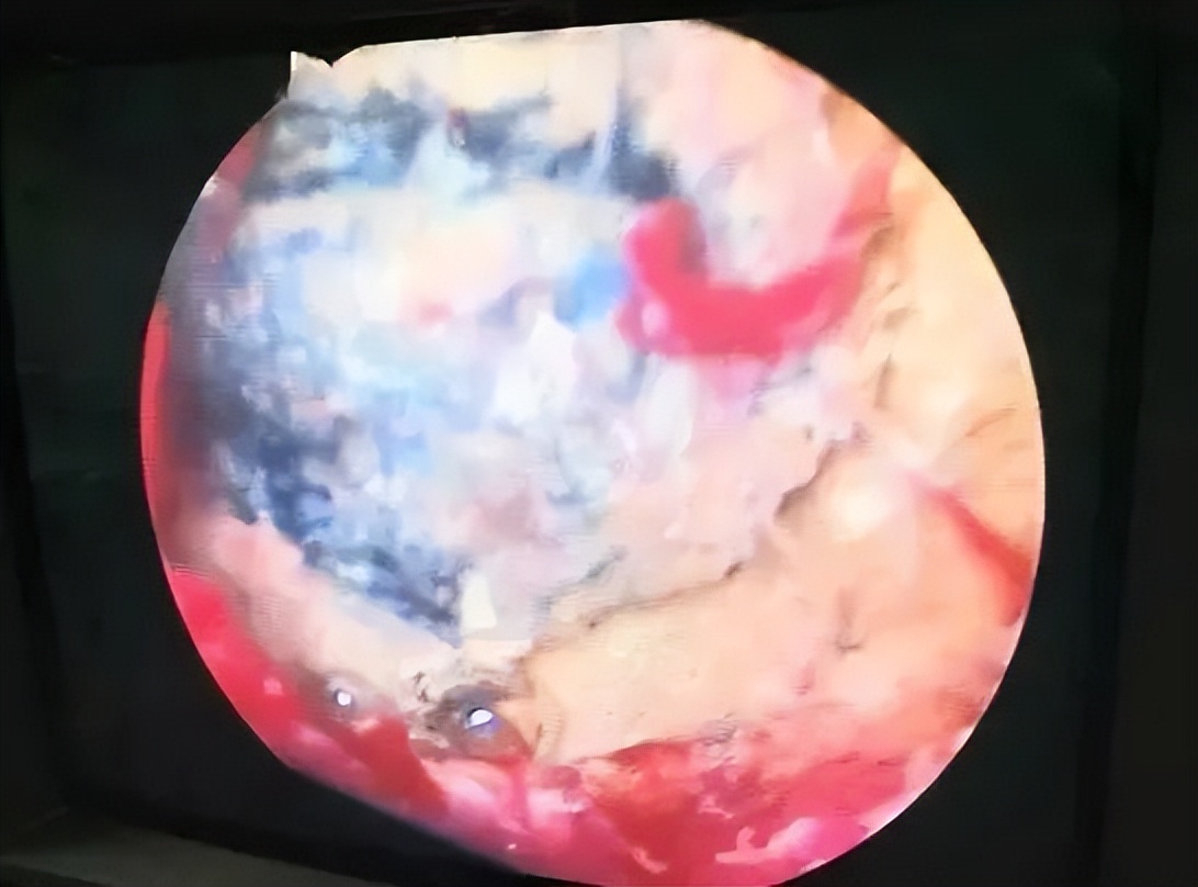 浙江6岁女童阴道内被这个小东西烧焦!祸因值得所有妈妈深思…