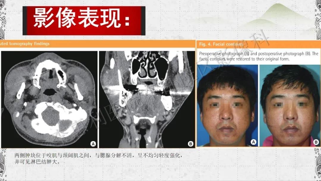 木村病治愈成功案例,木村病诊断案例