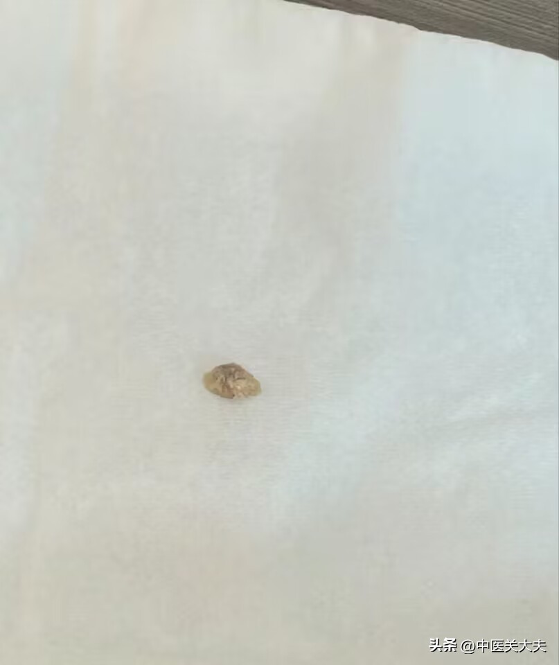 女性肾结石掉到输尿管怎么排石,15岁女孩肾结石能不能直接碎石