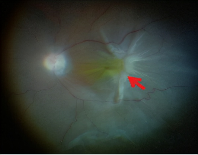 视网膜脱落复位手术,增生性玻璃体视网膜病变的表现