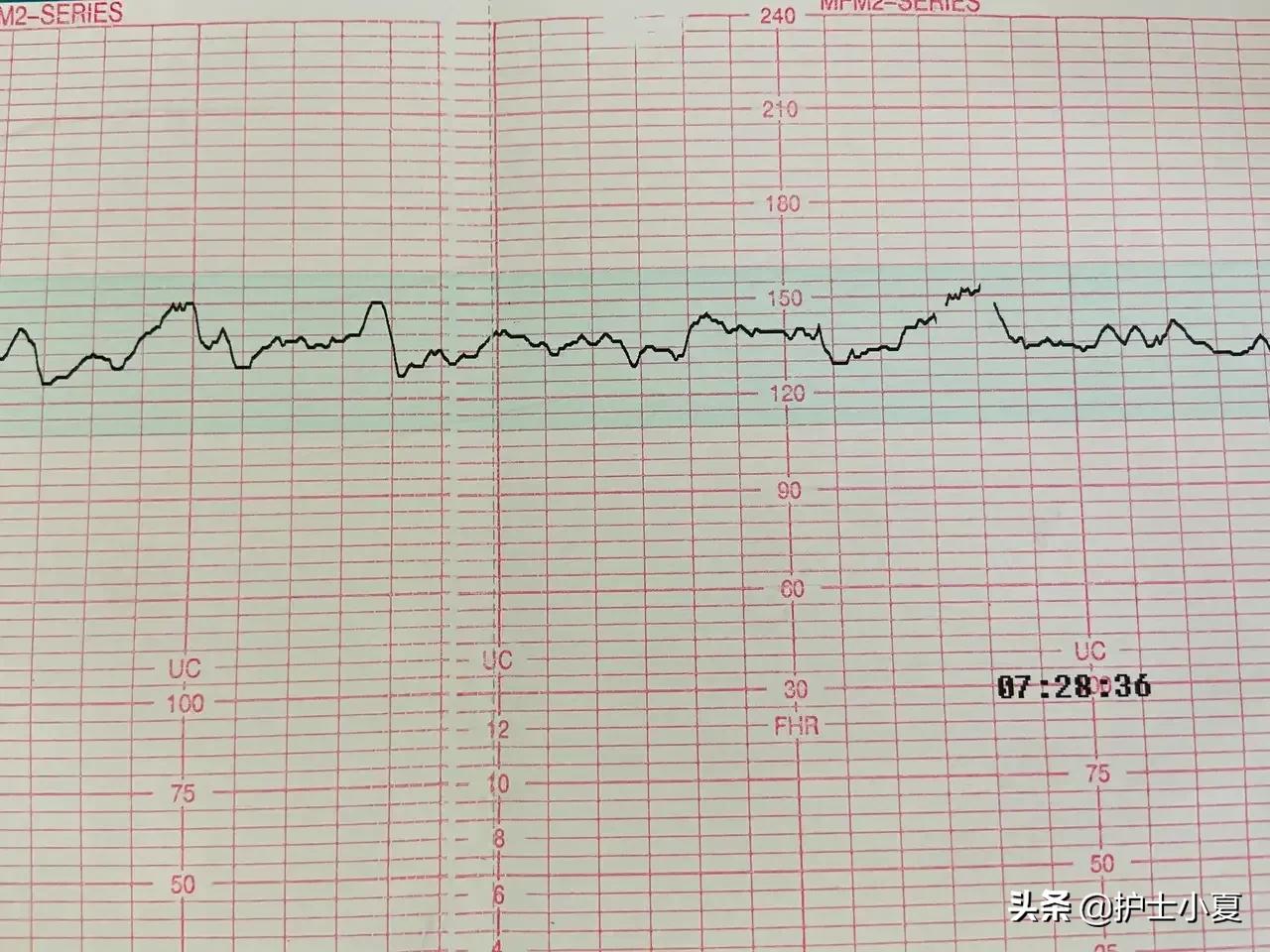 胎儿心律失常怎么办,胎儿心律失常呈三联律