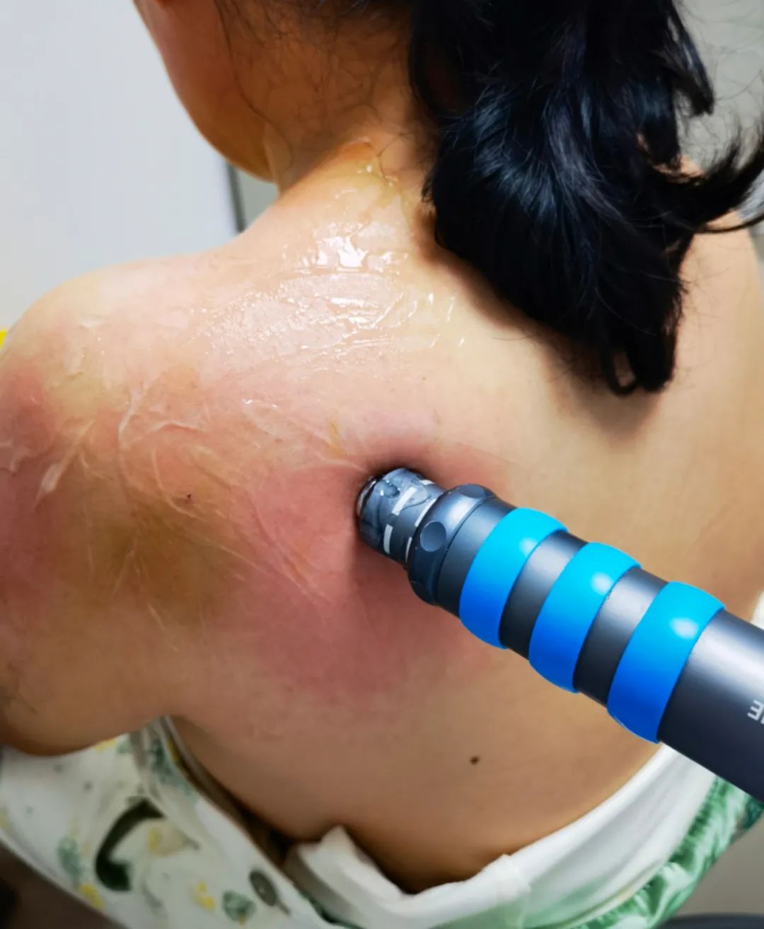 慢性疼痛理疗项目,慢性疼痛的新疗法