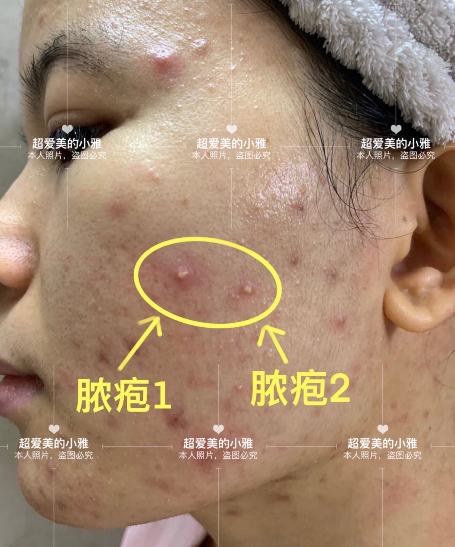 痘痘严重爆发如何战痘到底,痘痘的常见问题解决方法在这里