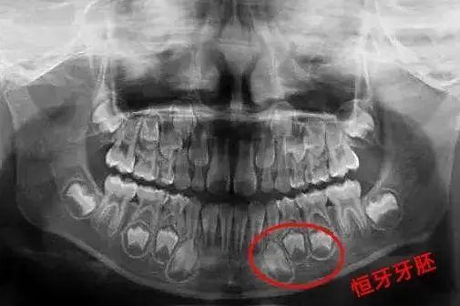 成年人患上牙瘤从牙里拔出57颗牙,一女生患牙瘤拔掉57颗牙
