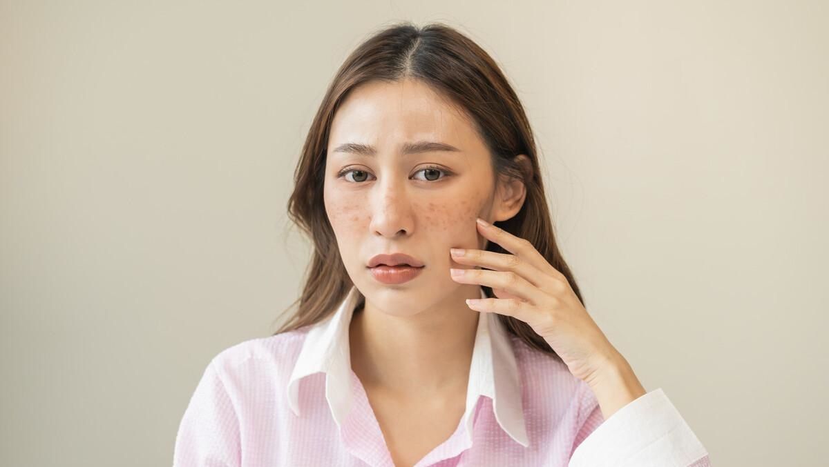 脸上长晒斑怎样才能最快消除斑,色斑晒斑的最佳去除方法