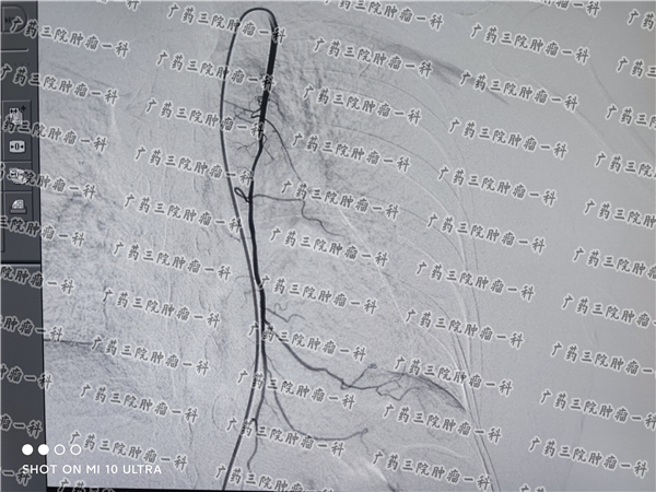 乳腺癌误诊误治赔偿,乳腺癌被误诊的几率高不高