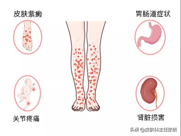过敏性紫癜是怎样的病,过敏性紫癜怎样治疗才能断根