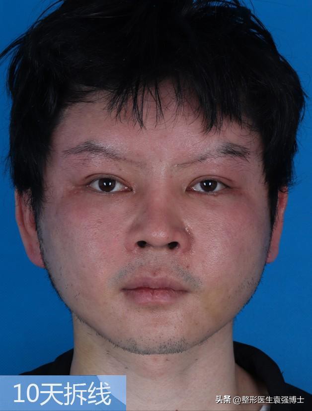 40岁大拉皮的效果,做大拉皮真的可怕吗