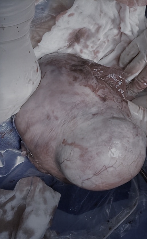 55岁女性绝经后突然来“月经”？原来是子宫淋巴瘤作祟