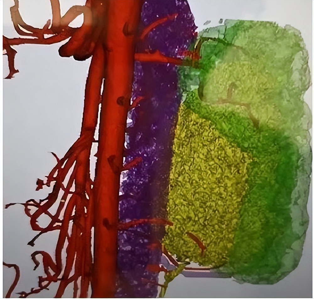 肾积水中医诊断治疗,中医治疗严重肾积水