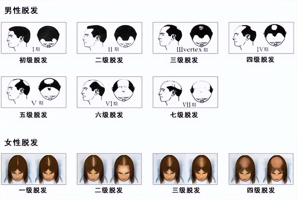 秃顶的福音让你自己长出头发,秃顶治好实例